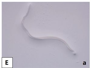 Penampakan 4 Cacing Ngumpet di Kelopak Mata Wanita, Awalnya Ngeluh Gatal Penampakan 4 Cacing Ngumpet di Kelopak Mata Wanita, Awalnya Ngeluh Gatal