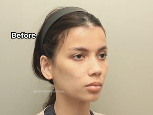 7 Foto Before-After Sabrina Istri Deddy Corbuzier Jalani Fat Graft 7 Foto Before-After Sabrina Istri Deddy Corbuzier Jalani Fat Graft