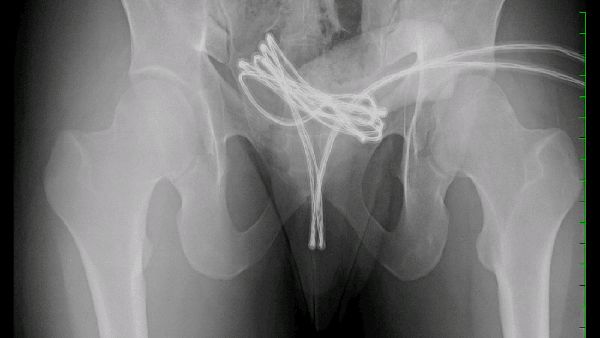 Ngilu! Sepanjang Ini Kabel USB yang Dikeluarkan Dokter dari Alat Kelamin Pria