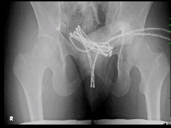 Aksi Gila Seorang Mahasiswa Masukkan Kabel USB ke Dalam Kelaminnya