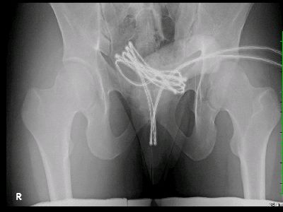 Ngilu! Sepanjang Ini Kabel USB yang Dikeluarkan Dokter dari Alat Kelamin Pria