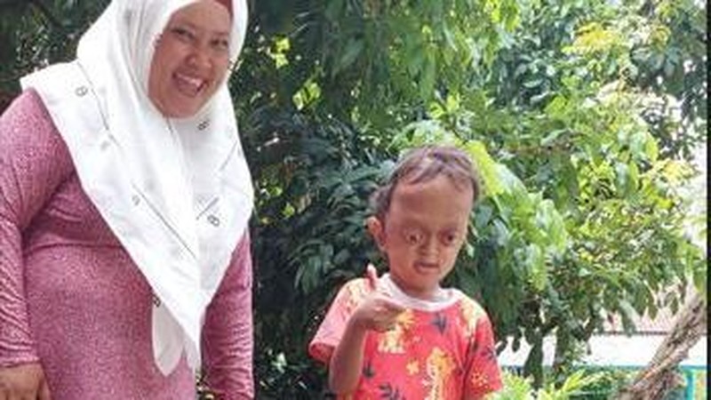 Kisah Si Kecil Aufan Derita Hidrosefalus, Crouzon Syndrome hingga Spina Bifida