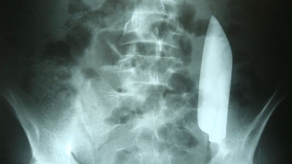 Momen Menegangkan Dokter Cabut Pisau Berukuran 15 Cm dari Perut Pria Ini