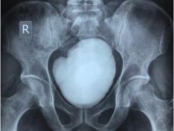 Dokter Temukan Batu Kandung Kemih Raksasa di Pasien Umur 35 Tahun