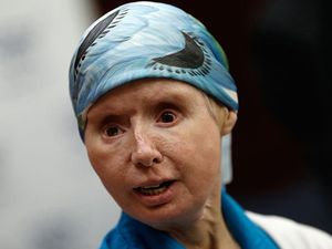 Curhat Wanita Wajahnya Rusak usai Diserang Simpanse, Sempat Mengira Tak Selamat Curhat Wanita Wajahnya Rusak usai Diserang Simpanse, Sempat Mengira Tak Selamat