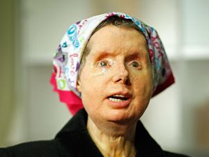 Foto Wanita Jalani Transplantasi Wajah, Mukanya Hancur Parah Diserang Simpanse Foto Wanita Jalani Transplantasi Wajah, Mukanya Hancur Parah Diserang Simpanse