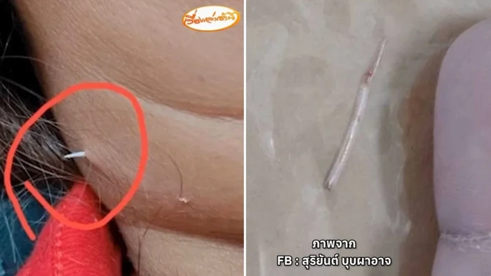 Wanita Ini Tersedak Duri Ikan Sampai Menembus Kulit Lehernya Wanita Ini Tersedak Duri Ikan Sampai Menembus Kulit Lehernya
