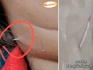 Wanita Ini Tersedak Duri Ikan Sampai Menembus Kulit Lehernya Wanita Ini Tersedak Duri Ikan Sampai Menembus Kulit Lehernya