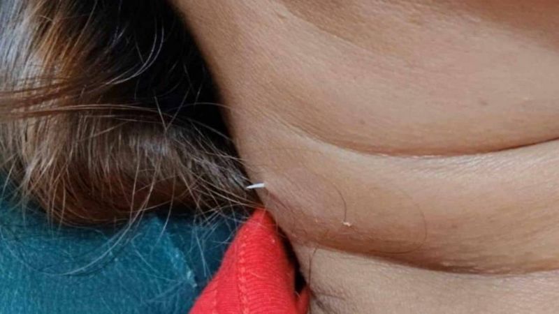 Wanita Ini Tersedak Duri Ikan Sampai Menembus Kulit Lehernya