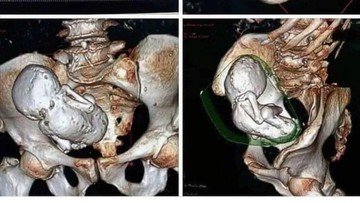 Viral CT Scan Bayi yang 'Membatu' di Perut Wanita, Sudah Ada Selama 30 Tahun!