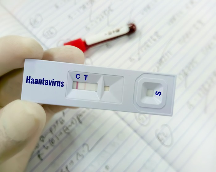 Hand of doctor holding a rapid test cassette for Hantavirus test, showing positive result, close up. Hanta virus
