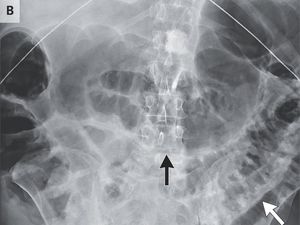 Tubuh Mungil Raya yang Dipenuhi Cacing, Ini Kata Pakar Kesehatan Unpad Tubuh Mungil Raya yang Dipenuhi Cacing, Ini Kata Pakar Kesehatan Unpad