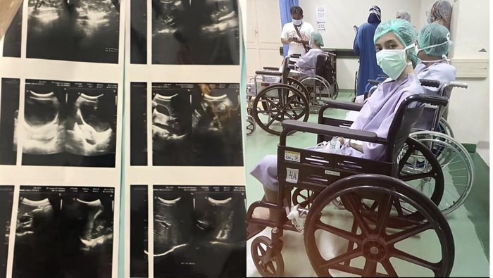 Seorang perempuan di Jaktim berusia 20 tahun, membuatkan pengalaman soal kanker usus yang dirasakan, mulai dari tanda-tanda nyeri perut hebat.