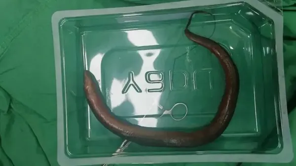 Momen Dokter Keluarkan Belut Hidup di Tubuh Pasien, Ada yang Panjangnya 65 Cm!