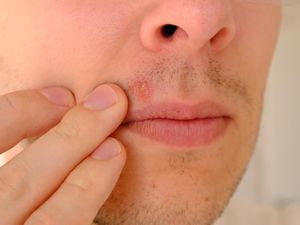 Jerawat di Bawah Hidung Tanda Lagi Jatuh Cinta? Ini Mitos dan Faktanya Jerawat di Bawah Hidung Tanda Lagi Jatuh Cinta? Ini Mitos dan Faktanya