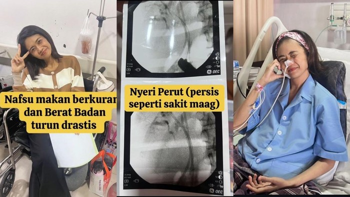 Wanita di Samarinda mengidap kanker kanal empedu stadium 4