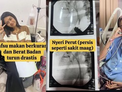 Gejala Kanker Saluran Empedu Dialami Wanita Samarinda: Urine Seperti Teh