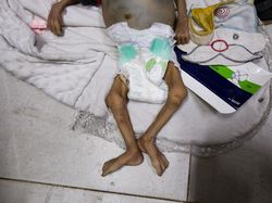 Dokter Ceritakan Ngerinya Kondisi Warga Termasuk Anak-anak di Gaza yang Kelaparan