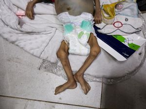 Dokter Ceritakan Ngerinya Kondisi Warga Termasuk Anak-anak di Gaza yang Kelaparan