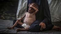 Malnutrisi Ancam Nyawa Anak-Anak di Gaza