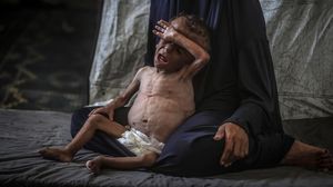 Malnutrisi Ancam Nyawa Anak-Anak di Gaza