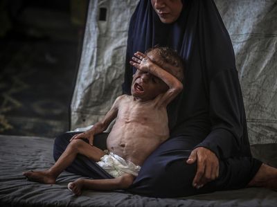 Malnutrisi Ancam Nyawa Anak-Anak di Gaza