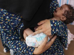 WHO: 99 Orang di Gaza Alami Malnutrisi, 29 Masih Balita
