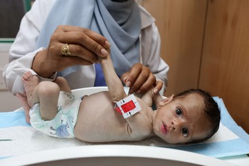Tubuh Ringkih Bayi Gaza, Lengan Selebar Jari Orang Dewasa