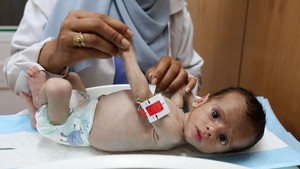 Tubuh Ringkih Bayi Gaza, Lengan Selebar Jari Orang Dewasa