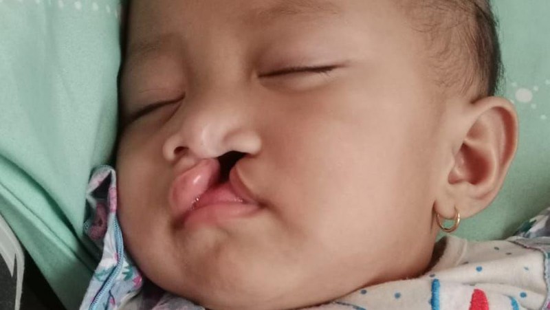Balita Khalisa Masih Perlu 3 Kali Operasi Bibir Sumbing, Ayo Bantu