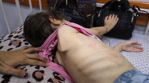 Potret Pilu Anak Palestina Bertahan dari Gizi Buruk di Tengah Perang