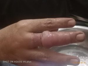 Ngilu! Evakuasi Cincin Mur Jembatan di Jari Lansia Kuningan