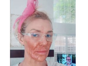 Apa yang Terjadi dengan Wajah Bintang Reality Show Ini? Kondisinya Makin Parah Apa yang Terjadi dengan Wajah Bintang Reality Show Ini? Kondisinya Makin Parah