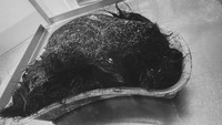 Gumpalan Rambut di Dalam Perut Gadis 16 Tahun, Dokter Beri Penjelasan