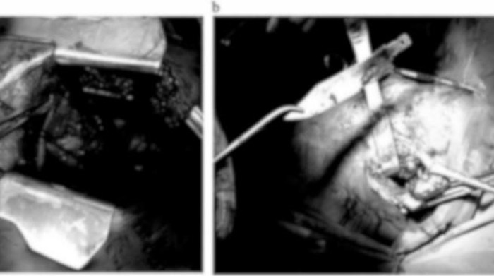 Pisau nyangkut di payudara pria Pisau nyangkut di payudara pria