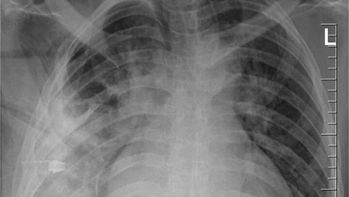 Pisau nyangkut di payudara pria Pisau nyangkut di payudara pria