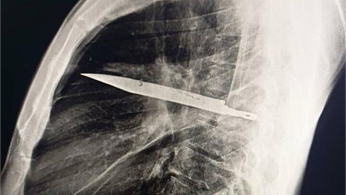 Pisau nyangkut di payudara pria Pisau nyangkut di payudara pria