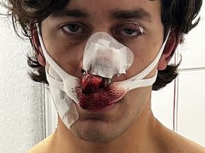 Model Ditikam Saat Bela Wanita, Wajah Luka Parah Hingga Hidung Terbelah