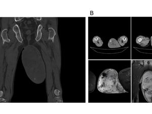 Penampakan Tumor di Buah Zakar Sebesar Telur Ayam, Inikah Pemicunya?