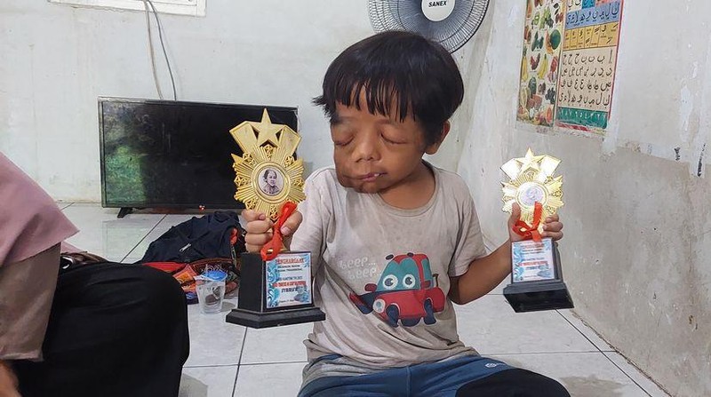 Kisah Pilu Ilyas, Bocah Penderita Tumor Getah Bening yang Sering Dirundung