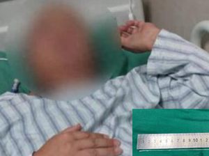 Gegara Makan Empedu Ular Mentah, Cacing Bersarang di Otak Pria Ini Gegara Makan Empedu Ular Mentah, Cacing Bersarang di Otak Pria Ini