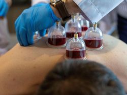 6 Titik Bekam Paling Ampuh untuk Detoks Tubuh ala Rasulullah