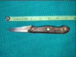 Ngilu! Dokter Temukan Pisau 17 Cm di Usus Pasien, Ternyata Ini Awal Mulanya