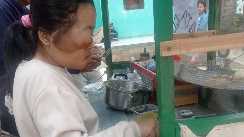 Yuk Bantu Resti, Anak Tukang Batagor Penderita Tumor Butuh Uluran Tangan