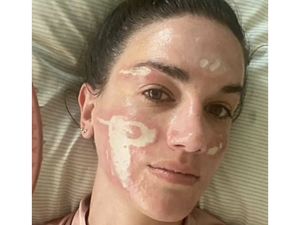 Wajah Wanita Ini Rusak Permanen Setelah Perawatan di Klinik Langganan Artis Wajah Wanita Ini Rusak Permanen Setelah Perawatan di Klinik Langganan Artis