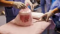 Peneliti AS Semakin Dekat Wujudkan Transplantasi Ginjal Babi untuk Manusia