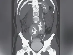 Aneh Tapi Nyata! Pria Ini Keluhkan Nyeri Punggung, Ternyata Punya 3 Ginjal