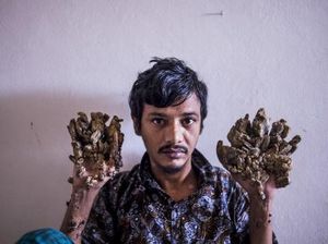 Pria Ini Kena Penyakit Langka, Tangan dan Kakinya Bak Kulit Kayu
