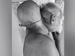 Pria 65 Tahun Punya Tumor Sebesar Kepala, Sempat Percaya Bisa Sembuh Sendiri