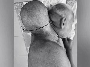 Cerita Pria Punya Tumor Raksasa Sebesar Kepala, Tolak ke RS Selama 16 Tahun Cerita Pria Punya Tumor Raksasa Sebesar Kepala, Tolak ke RS Selama 16 Tahun